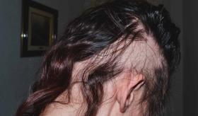 Alopecia androgénica: Desencadenada por varios factores como el envejecimiento, el estrés entre otros
