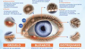 Trastornos de los p&aacute;rpados | Infograf&iacute;a