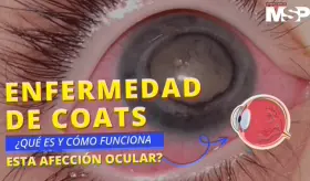 Enfermedad de Coats: &iquest;Qu&eacute; es y c&oacute;mo funciona esta afecci&oacute;n ocular?