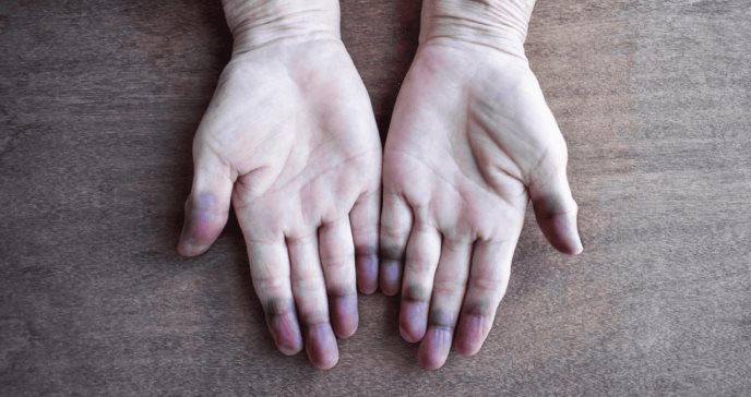 Acrocianosis, una de las últimas secuelas identificadas del COVID persistente