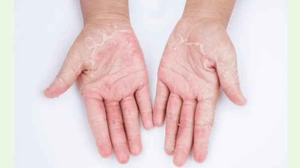 Jabones, detergentes y otros irritantes: ¿Qué causa la dermatitis de contacto? Jabones, detergentes y otros irritantes: ¿Qué causa la dermatitis de contacto?