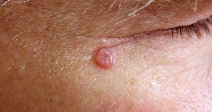 Masa roja en el rostro o cuello: así puede identificar el carcinoma de células de Merkel