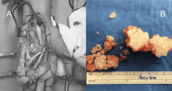 Radiación adyuvante resulta efectiva en paciente con sinovitis villonodular pigmentada recurrente