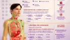 Linfoma - Infografía