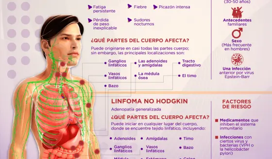 Linfoma - Infografía