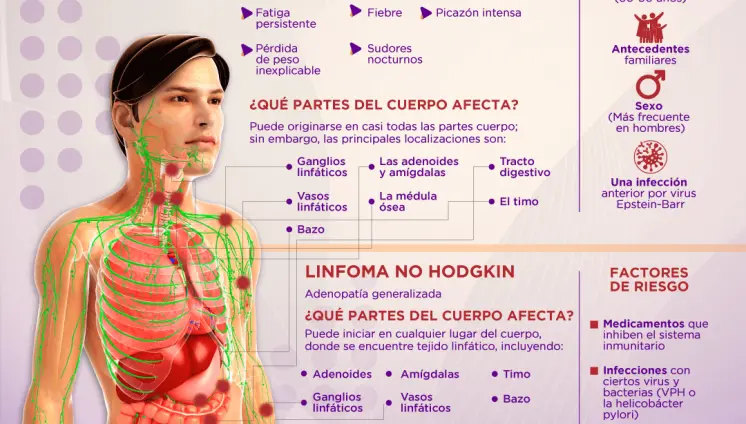 Linfoma - Infografía