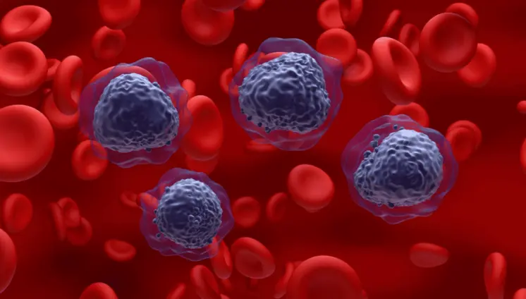 Cinco puntos claves para comprender la Leucemia Mieloide Aguda