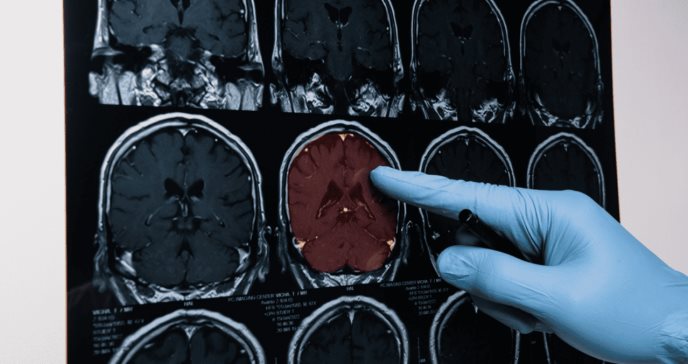 ¿Se pueden prevenir los ictus? Esto dice la ciencia