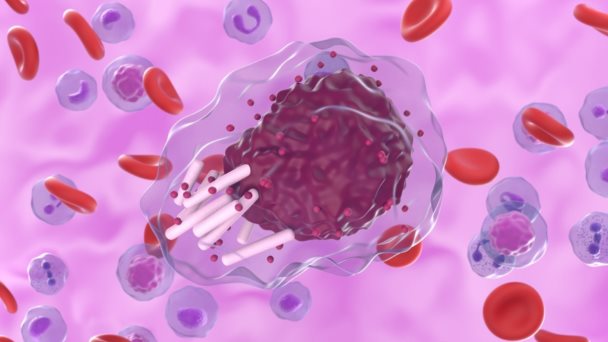 Linfoma linfocítico pequeño: cáncer inmunológico que puede afectar cualquier órgano Linfoma linfocítico pequeño: cáncer inmunológico que puede afectar cualquier órgano