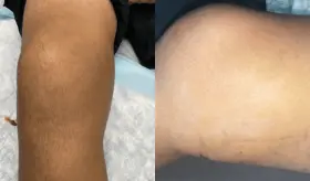 Dolor de rodilla por contusión culmina con diagnóstico de lesión de Morel-Lavallée en Puerto Rico