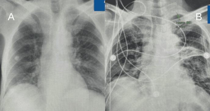 Paciente con VIH presentó tensión en el pecho y dificultad respiratoria tras empiema 