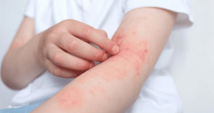 Dermatitis atópica: ¿Cómo la biotecnología ha transformado los tratamientos en la última década?