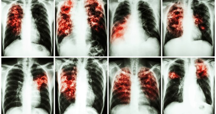 Publican nueva guía para manejo de enfermedad pulmonar intersticial en pacientes con enfermedad reumática