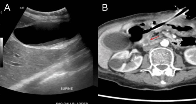 Sonda de gastrostomía causa colecistitis acalculosa por obstrucción en drenaje biliar a mujer de 81 años