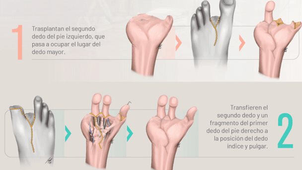 Especialistas reconstruyen mano de joven tras accidente utilizando los dedos de sus pies