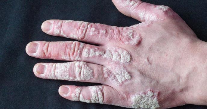 Brepocitinib: el fármaco en investigación que demostró reducir los síntomas de la artritis psoriásica