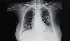 Dos pacientes desarrollan múltiples tumores primarios en Puerto Rico