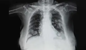 Dos pacientes desarrollan múltiples tumores primarios en Puerto Rico