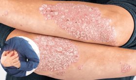 Psoriasis grave aumenta el riesgo cardiovascular, según estudio