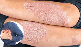 Psoriasis grave aumenta el riesgo cardiovascular, seg&uacute;n estudio