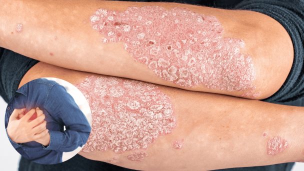 Psoriasis grave aumenta el riesgo cardiovascular, según estudio Psoriasis grave aumenta el riesgo cardiovascular, según estudio
