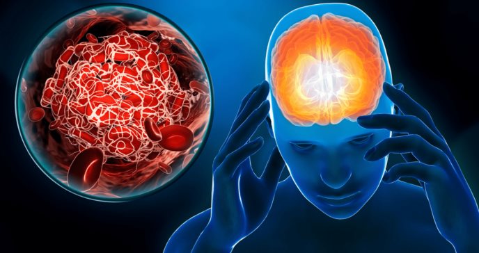 Apnea del sueño podría aumentar de dos a tres veces el riesgo de sufrir un infarto cerebral en jóvenes