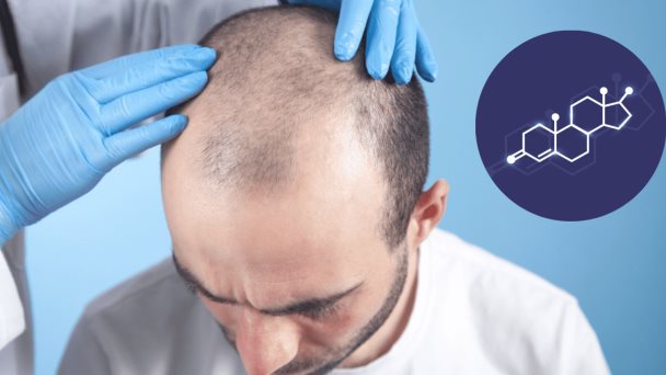 Disminución de niveles de testosterona estaría relacionado con la pérdida de cabello en hombres Disminución de niveles de testosterona estaría relacionado con la pérdida de cabello en hombres