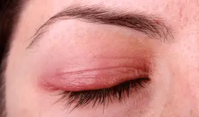 Los 7 distintos tipos de infecciones oculares que pueden causar p&eacute;rdida permanente de la visi&oacute;n