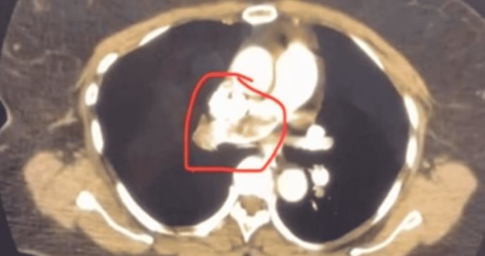 En Puerto Rico tratan casos diferenciales de embolia pulmonar submasiva en pacientes postoperatorios