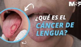 Todo lo que debes saber sobre el cáncer de lengua en 1 minuto - #ExclusivoMSP