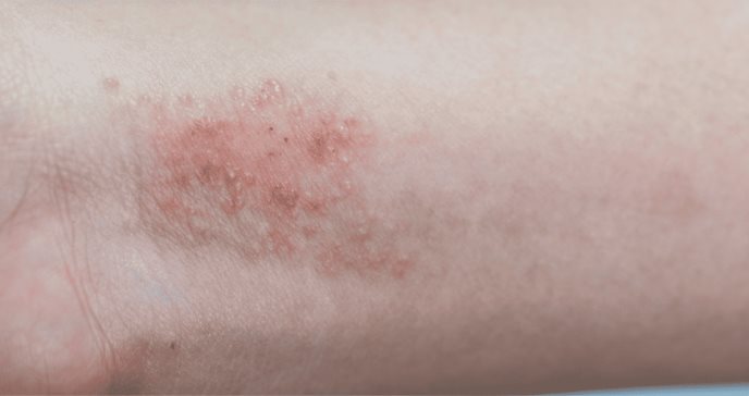 Péptidos antimicrobianos tienen potencial para tratar la dermatitis atópica, revela estudio