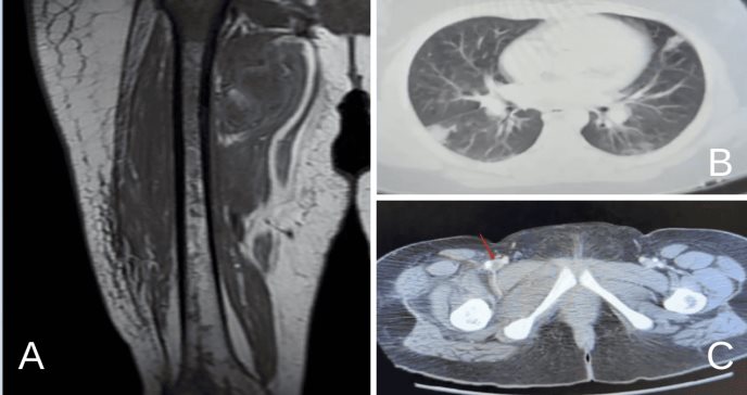 Complicación de trombosis venosa profunda causa inusual cojera unilateral en paciente pediátrica