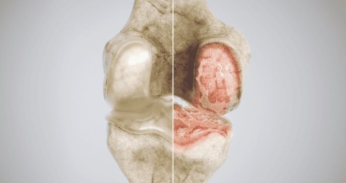 ¿Qué es la osteoartritis? Mil millones de personas la padecerán en 2050