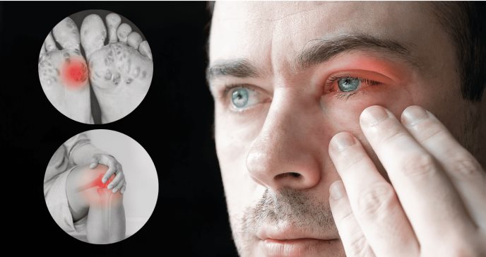 Artritis reactiva: ¿Cómo funciona esta respuesta inflamatoria a infecciones bacterianas como la clamidia?