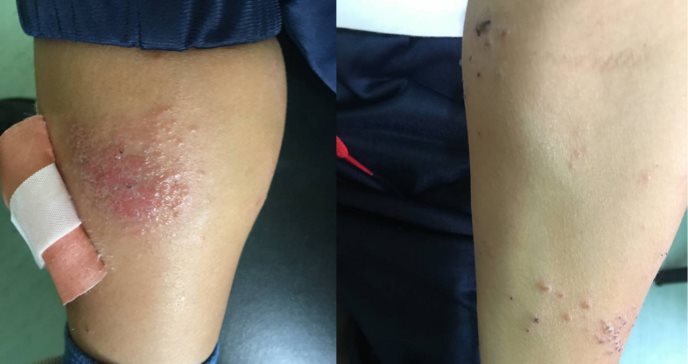 Paciente con dermatitis atópica desarrolla inusual infección causada por bacteria intestinal