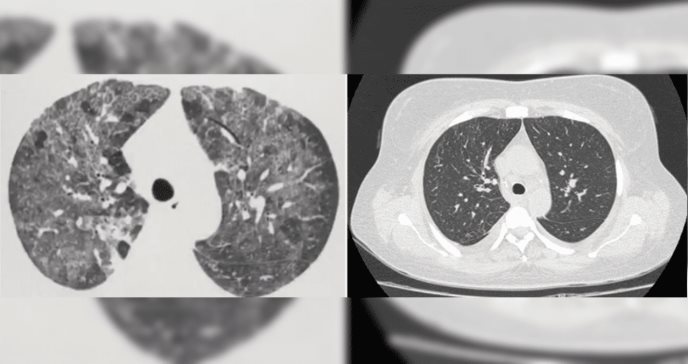 Rara complicación de neumonitis por metotrexato como tratamiento para la artritis reumatoide