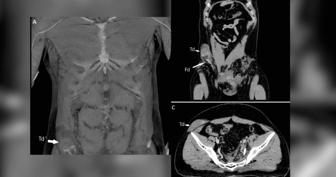 Testículo de un hombre se desplaza hasta su abdomen por accidente en motocicleta