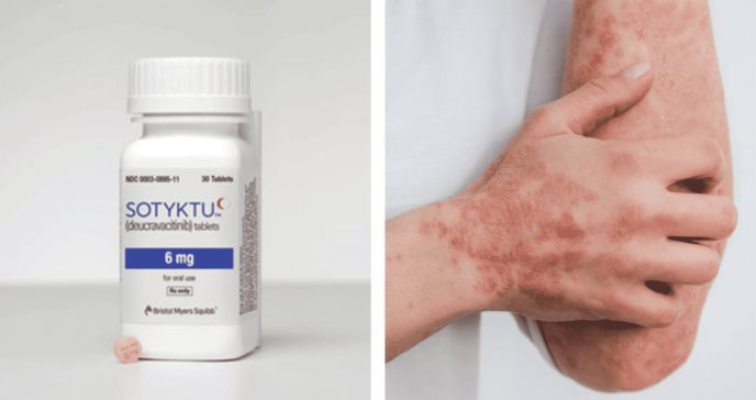 Sotyktu demuestra resultados positivos para el tratamiento de la psoriasis en placa a los 3 años