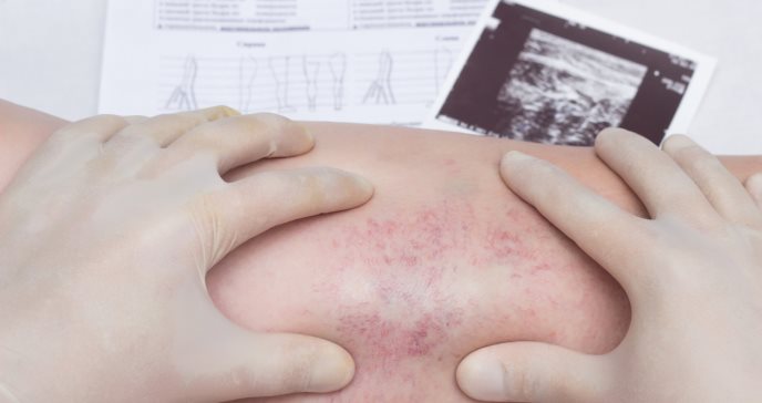 Riesgo de trombosis venosa profunda posterior a una cirugía: prevención, cuidados y tratamientos