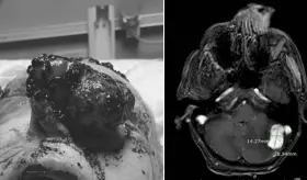 Masa anormal en la nariz culmina con un diagnóstico de melanoma metastásico