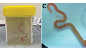 Inédito: extraen parásito de serpiente vivo del cerebro de una mujer