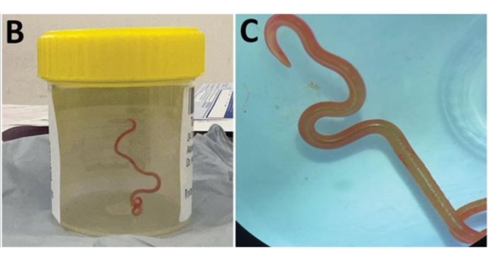Inédito: extraen parásito de serpiente vivo del cerebro de una mujer