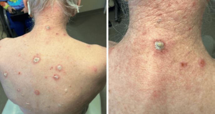 Medicamento para el cáncer provoca aparición inusual de psoriasis en cuello y espalda