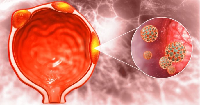 Síndrome metabólico aumentaría el riesgo de desarrollar cáncer de próstata agresivo