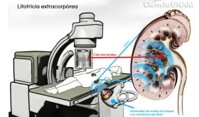 Litotricia extracorpórea: así funciona la técnica que alivia la pesadilla de los cálculos renales