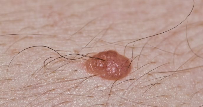Los lunares como foco para tratar la alopecia: revolucionaria y prometedora perspectiva 