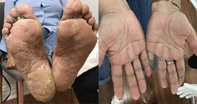 Raro caso de psoriasis verrugosa es tratado efectivamente con apremilast