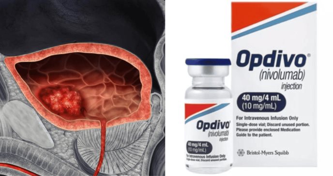 Opdivo combinado con quimioterapia de cisplatino reduce riesgo de mortalidad en un 22 %