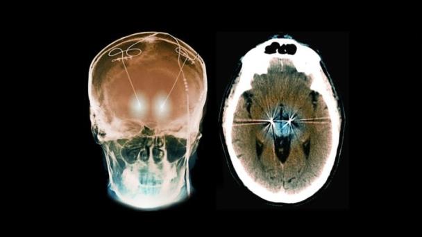Implante cerebral personalizado frena síntomas de Trastorno Obsesivo-Compulsivo en paciente con epilepsia