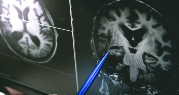 Identifican daños cerebrales y patologías vasculares en mujeres víctimas de violencia de género